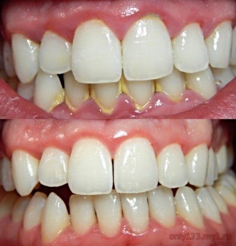 როგორ მოვიშოროთ ყვითელი ნადები კბილებიდან 5 წუთში, სტომატოლგთან ვიზიტის გარეშე